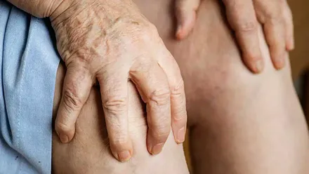 Métodos naturales para combatir la artritis y la inflamación