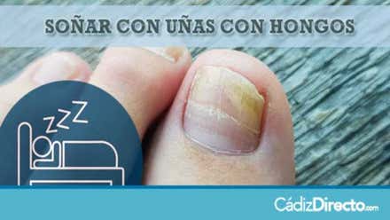 Hongos en las Uñas