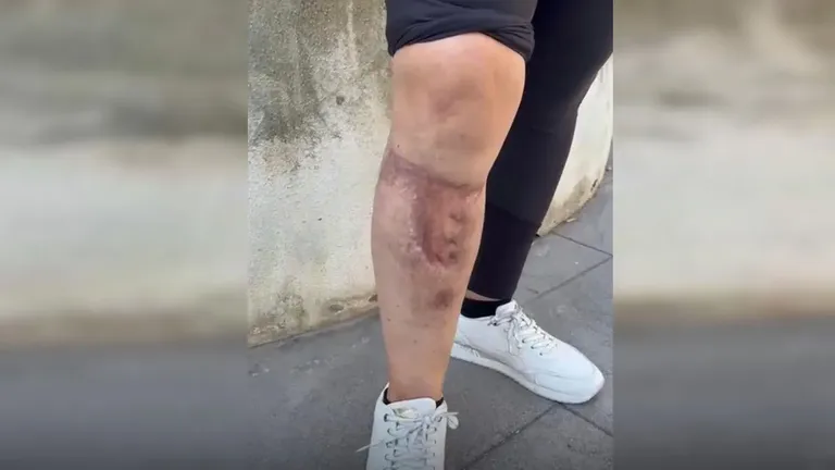 Herida en la pierna de la vecina lesionada.