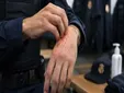 Cómo prevenir y tratar la sarna: las medidas básicas para cortar el contagio y evitar que vuelva
